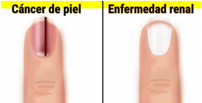 La leuconiquia o uñas con manchas blancas  Institut Català del Peu