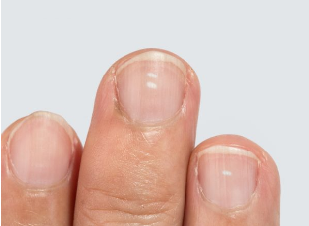puenting Completo Promover 10 signos de las uñas que revelan mucho sobre tu salud. Si ves líneas negras  consulta a tu médico | Uñas | Afección | síntomas | The Epoch Times en  español