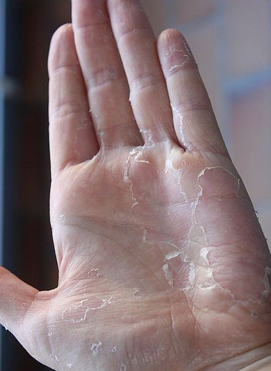 Posibilidades Casco Memorizar 10 cosas que tus manos pueden decir sobre tu salud. ¿Tienes manos secas,  rojas o frías? | Enfermedades | The Epoch Times en español